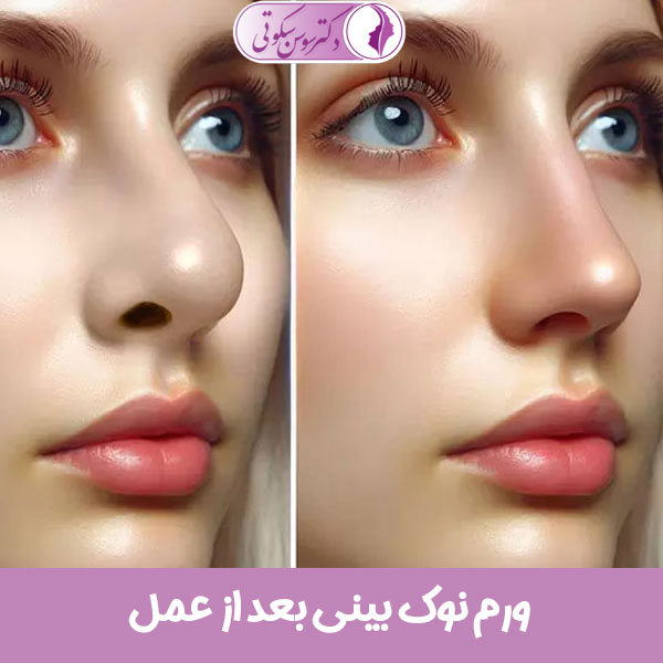 ورم نوک بینی بعد از عمل
