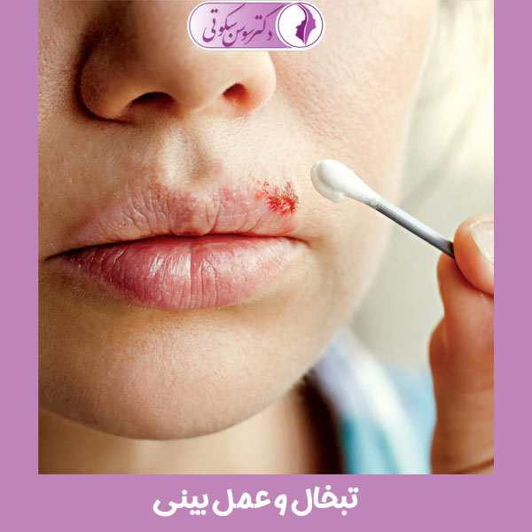 تبخال و عمل بینی