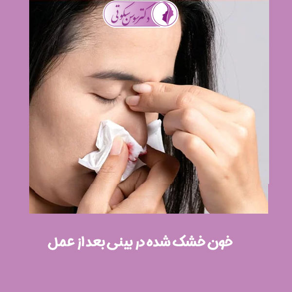 خون خشک شده در بینی بعد از عمل