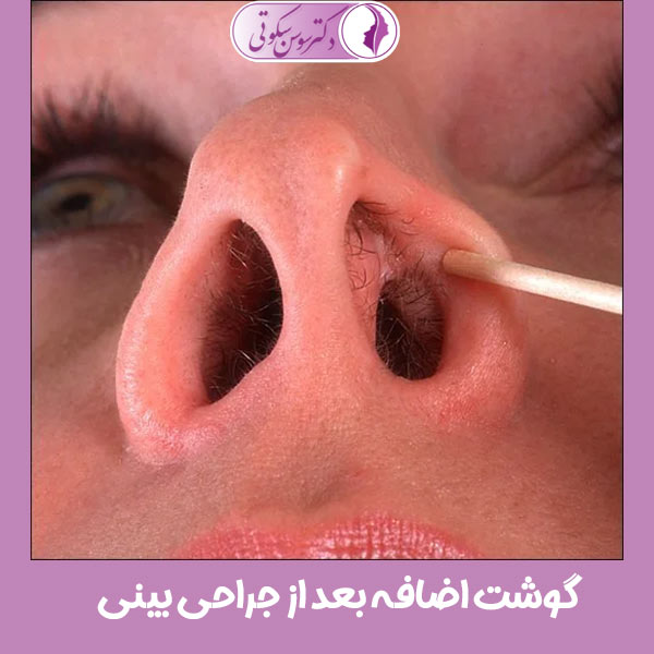 گوشت اضافه بعد از جراحی بینی