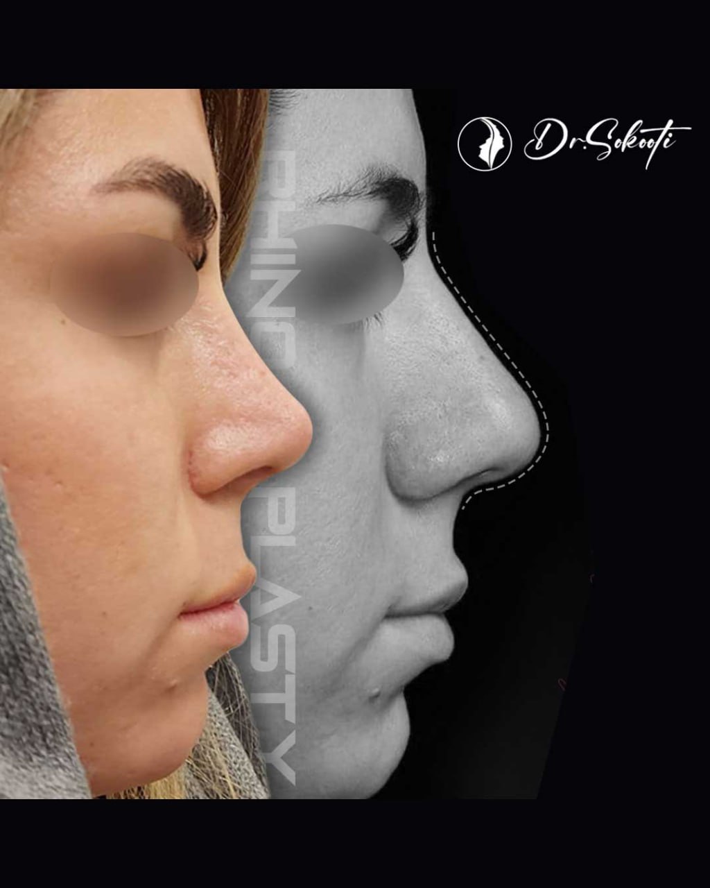 جراحی بینی طبیعی